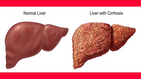 Cirrhosis